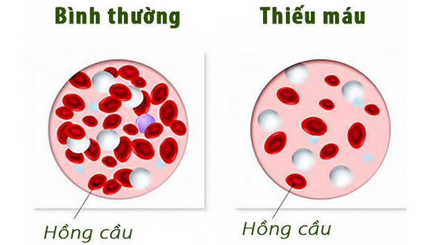 benh-thieu-mau