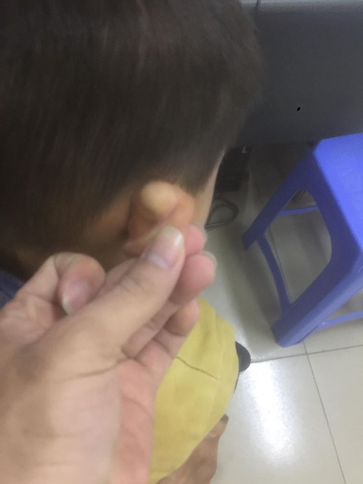 cắt u bã đậu tại bệnh viện đa khoa hòa bình (1)