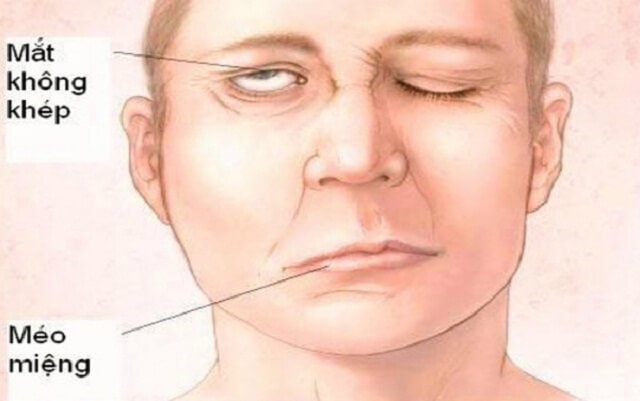 Liệt dây thần kinh số VII (liệt mặt) có nguy hiểm không? | Vinmec