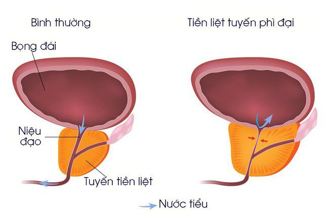 Phì đại tiền liệt tuyến có đáng sợ như bạn nghĩ 0