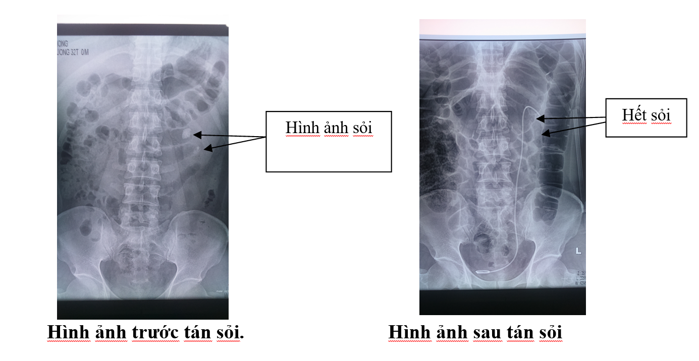 tan-soi-ngoai-da