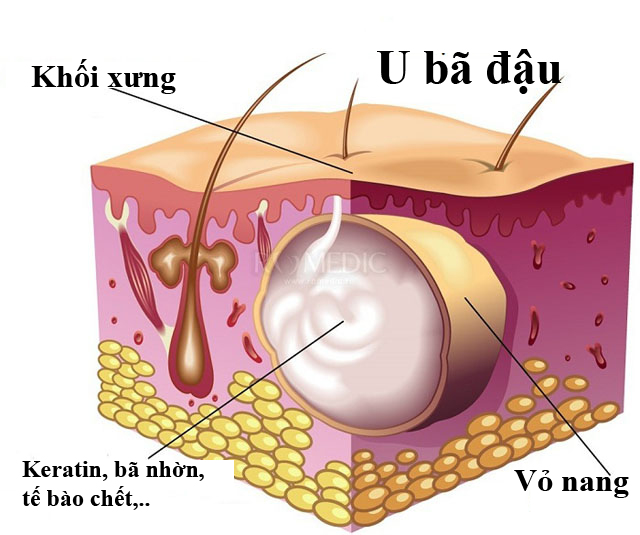 U bã đậu