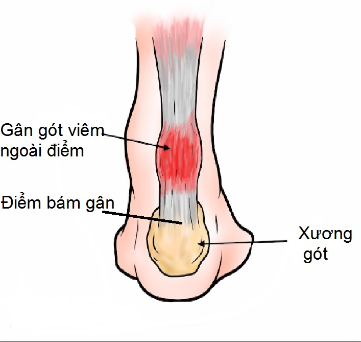 viêm điểm bám gân