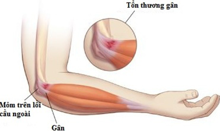 Viêm điểm bám gân có nguy hiểm không Viêm điểm bám gân có nguy hiểm không