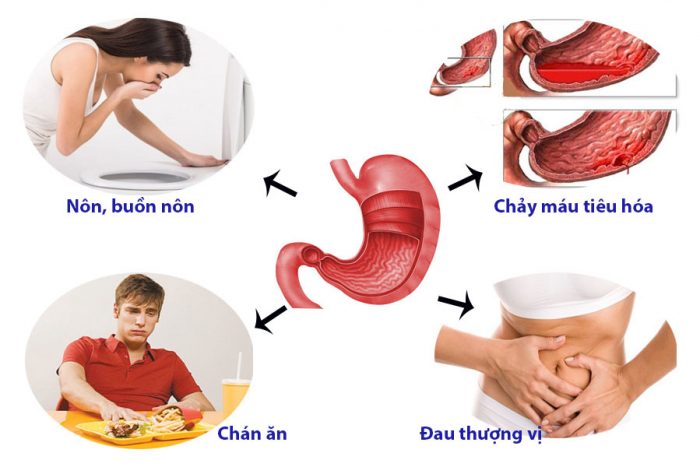 trieu-chung-dau-da-day-1-700x467